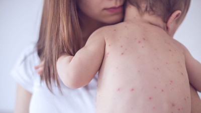 Measles cases surge in Europe amid rise in global outbreaks, WHO says