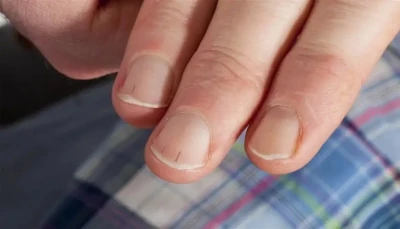علامة خفية في الأصابع قد تكشف ارتفاع الكوليسترول في الدم