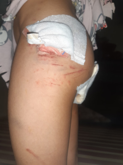 كلب شرس يهاجم  طفلة وسط غياب المسؤولية